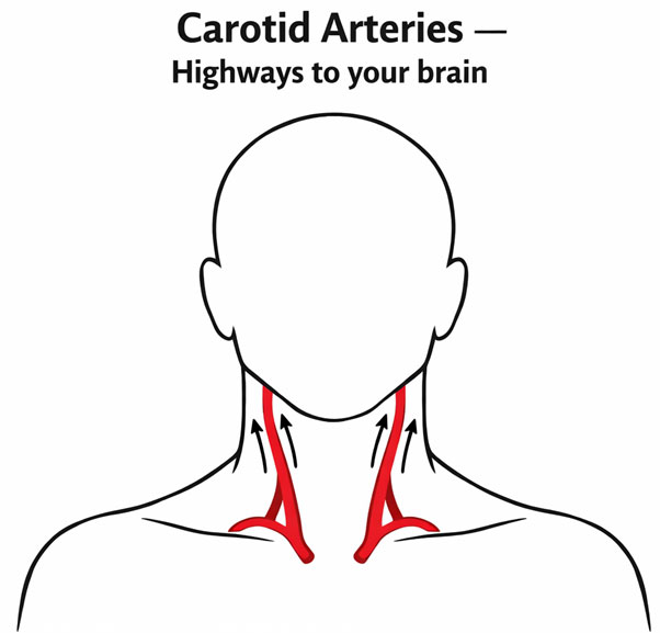 Best Arotid Artery Blockage Treatment Thane