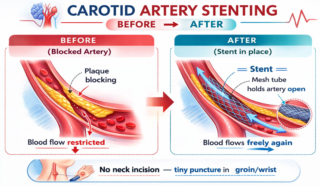 Expert Surgeon For Carotid Artery Stenting in Thane