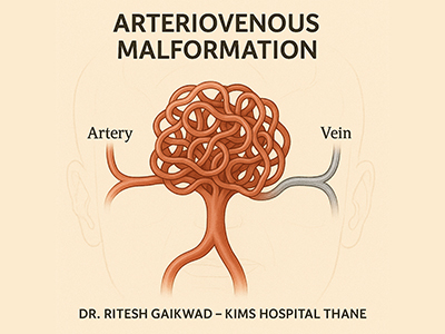 Vascular Malformation Treatment in Thane