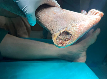 doctor for gangrene treatment thane