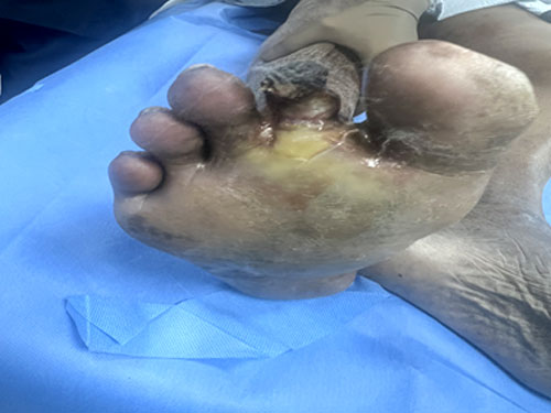 Carbondioxied Angiography Treatment in Thane