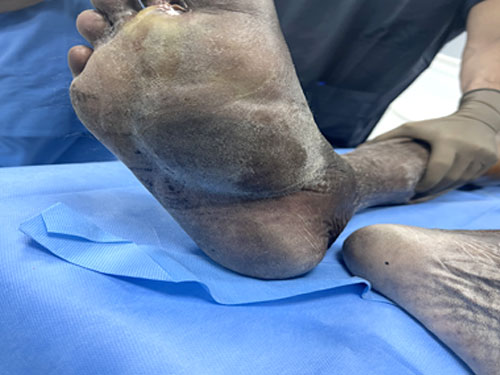 Carbondioxied Angioplasty Treatment in Thane