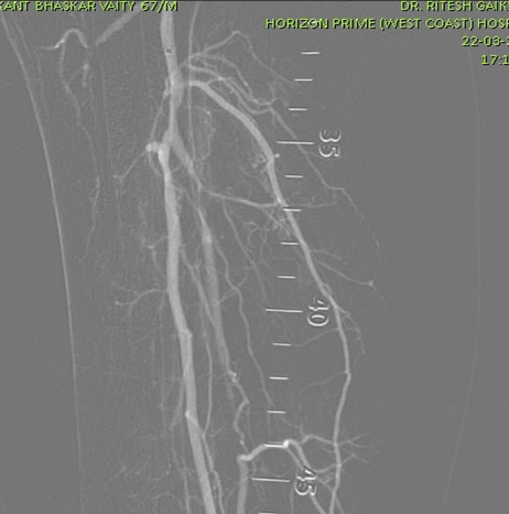 Extensive Blocks in Below Knee Arteries Treatment in Thane