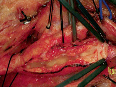 Doctor For Carotid Artery Stenosis Doctor For Carotid Artery Stenosis in Thane