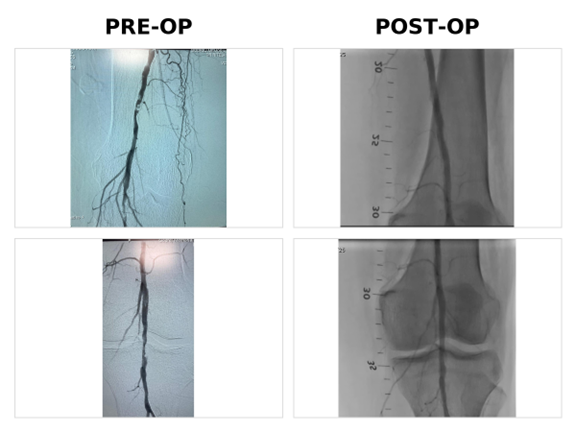 ABI + Doppler evaluation for PAD & gangrene diagnosis ABI + Doppler evaluation for PAD & gangrene diagnosis0