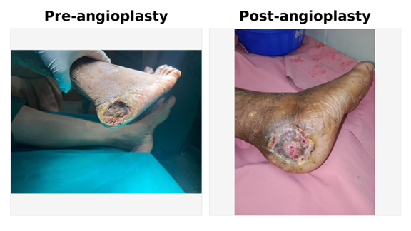 Infection control with limb-saving debridement – Dr. Ritesh Gaikwad Infection control with limb-saving debridement – Dr. Ritesh Gaikwad