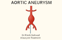 Best Doctor For Aneurysms Treatment in Thane