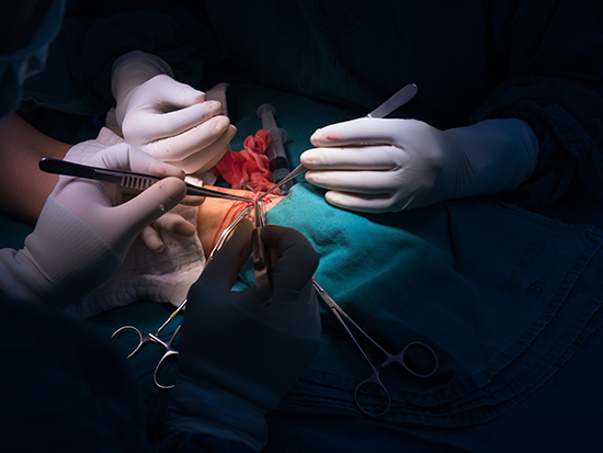AV Fistula Av Fistula For Dialysis Repair in Thane
