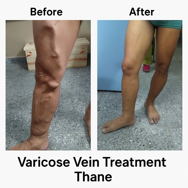 Best Varicose Veins Doctor in Thane - Dr Ritesh Gaikwad Varicose Veins Treatment in Thane