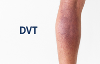 Best Deep Vein Thrombosis Treatment in Thane