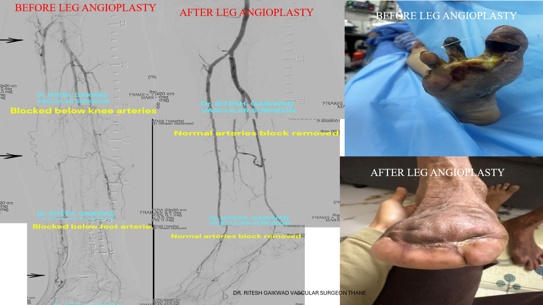 Dr. Ritesh Gaikwad Vascular surgeon and Endo Vascular surgeon